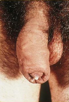 圖 1,淋病導致的男性尿道出現膿狀分泌物,這些排洩物從尿道口排出。